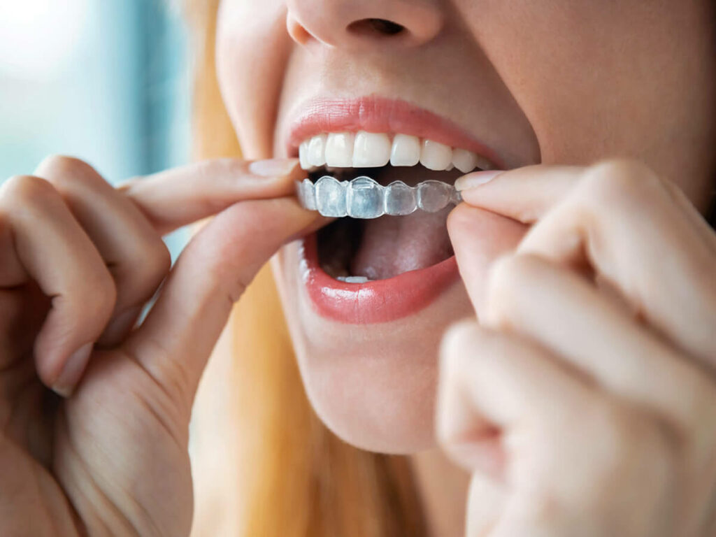 woman putting in an invisalign clear aligner