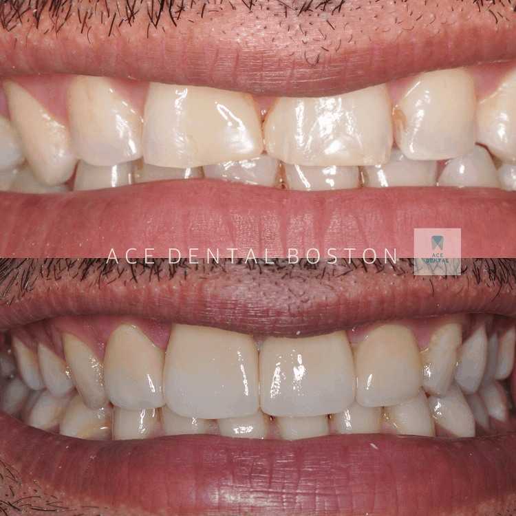 before and after photos of teeth without veneers and teeth with veneers