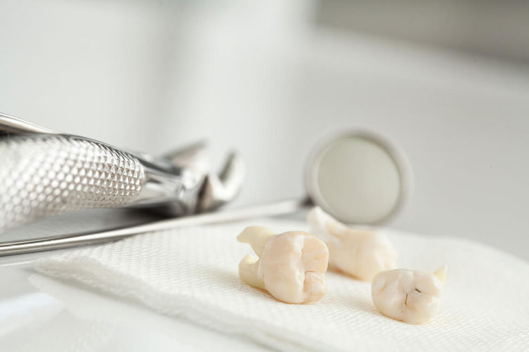 Four pulled teeth sitting next to dental tools