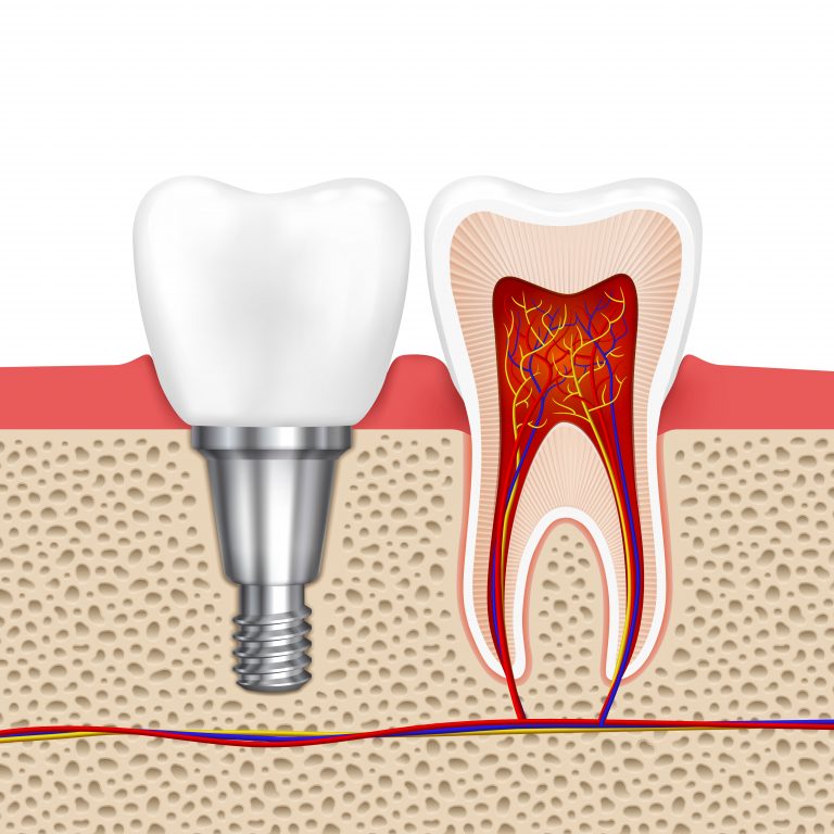 illustration depicting a dental implant and cross section of a tooth with inflamed roots requiring root canal