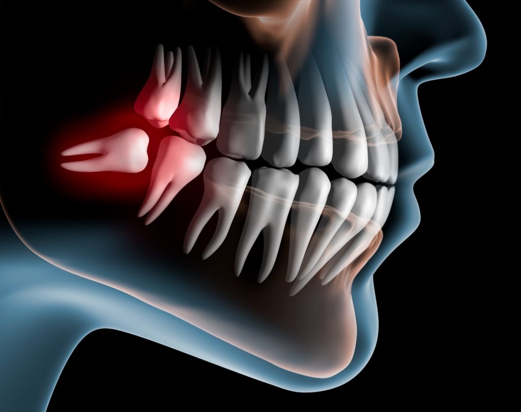 Illustration of a dental x-ray showing an inflamed wisdom tooth growing in sideways