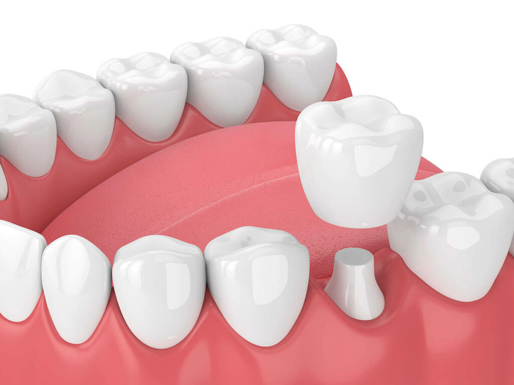 How Much Are Crowns at Ace Dental?