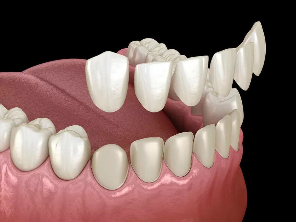 Illustration of a dental bridge showing the replacement teeth anchored to adjacent natural teeth.