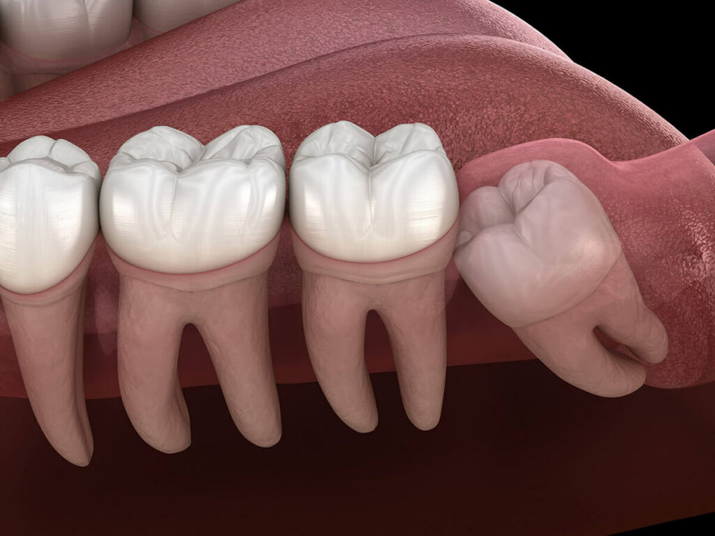 Does Ace Dental Do Wisdom Teeth Removal?