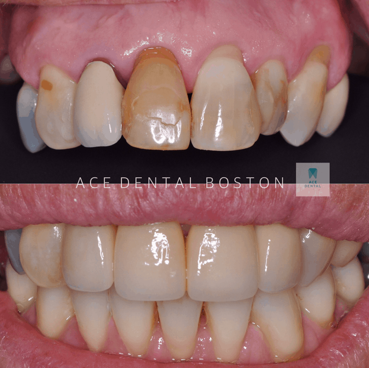 one set of brown, yellow, and crooked teeth and one set of teeth after cosmetic crowns are applied that are straight and whiter
