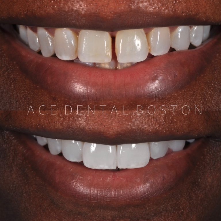 before and after photos of teeth without veneers and teeth with veneers