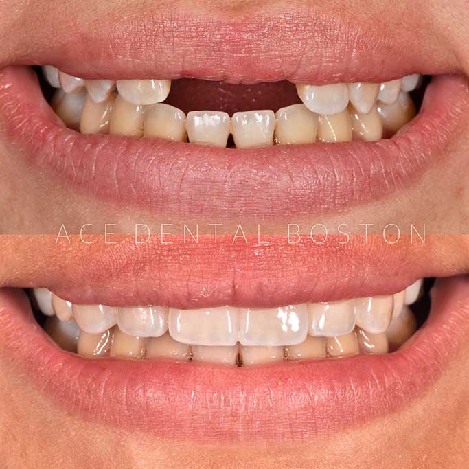 before and after of a person with missing teeth who received dental implants and veneers from Ace Dental Boston in Hyde Park