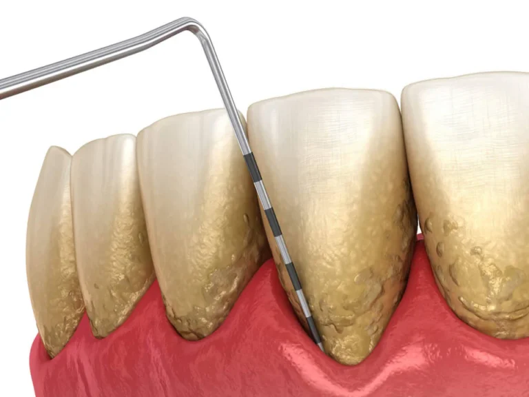 Gum disease treatment and periodontal treatment at Ace Dental Boston in Boston, MA