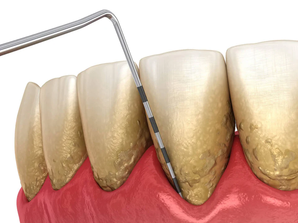 Gum disease treatment and periodontal treatment at Ace Dental Boston in Boston, MA