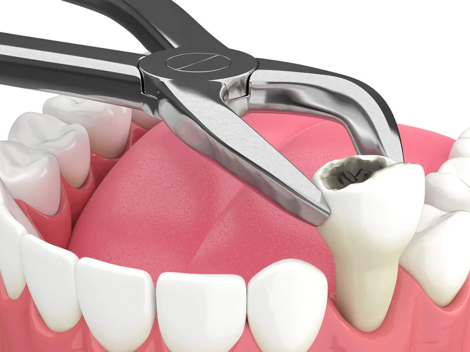 Tooth extraction services at Ace Dental Boston in Boston, MA